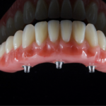 Kauno klinikos „Angitia“ daktaras – tarp pirmųjų 50-ies pasaulio odontologų, turinčiųjų teisę dirbti su unikalia dantų implantavimo sistema