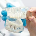 Dantų implantai – svajonė, tapusi kasdienybe