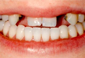 Kiek laiko užtrunka dantų implantacija?