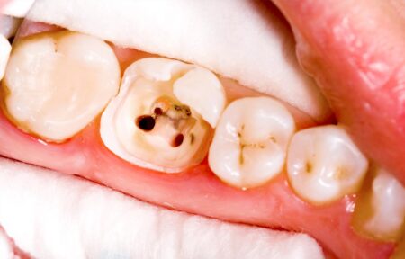 Dantų kanalų (endodontinis) gydymas