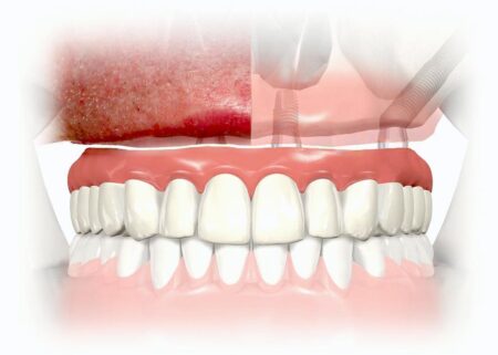 Ilgieji dantų implantai „Zygoma“ – 1 diena užuot 6 mėnesiai