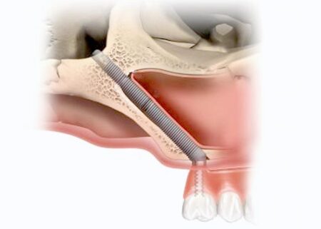 Ilgieji dantų implantai „Zygoma“ – 1 diena užuot 6 mėnesiai