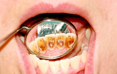 Patamsėję dantys