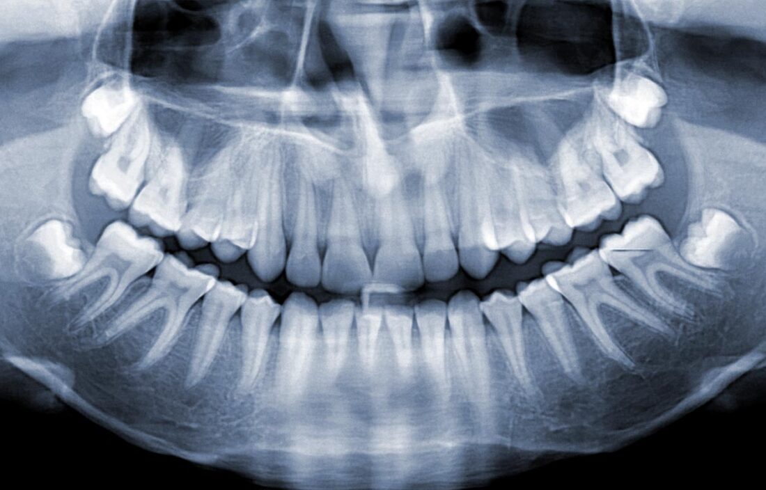 Protinio danties šalinimas