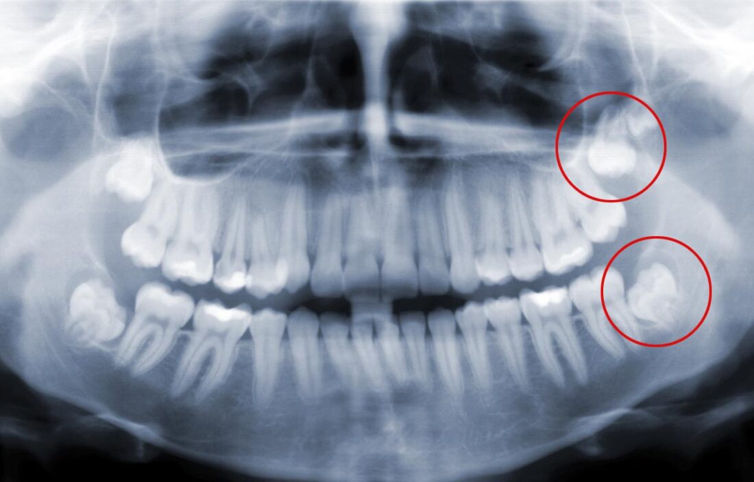 Protinių dantų chirurginis rovimas