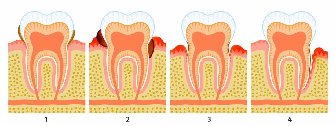 Uždelsto dantų gydymo pasekmės