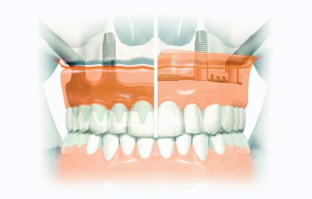 Dantų implantai, implantacija