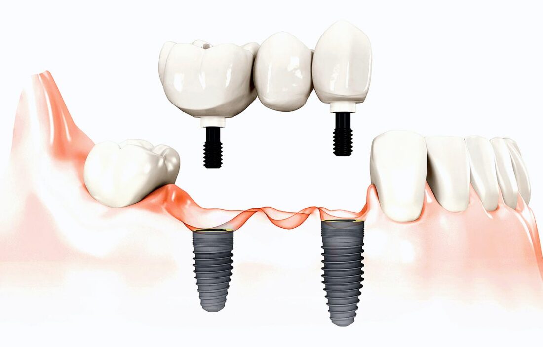 Dantų implantai, implantacija