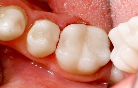 Dantų protezavimo būdai