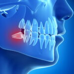 Kai dantį rauti būtina