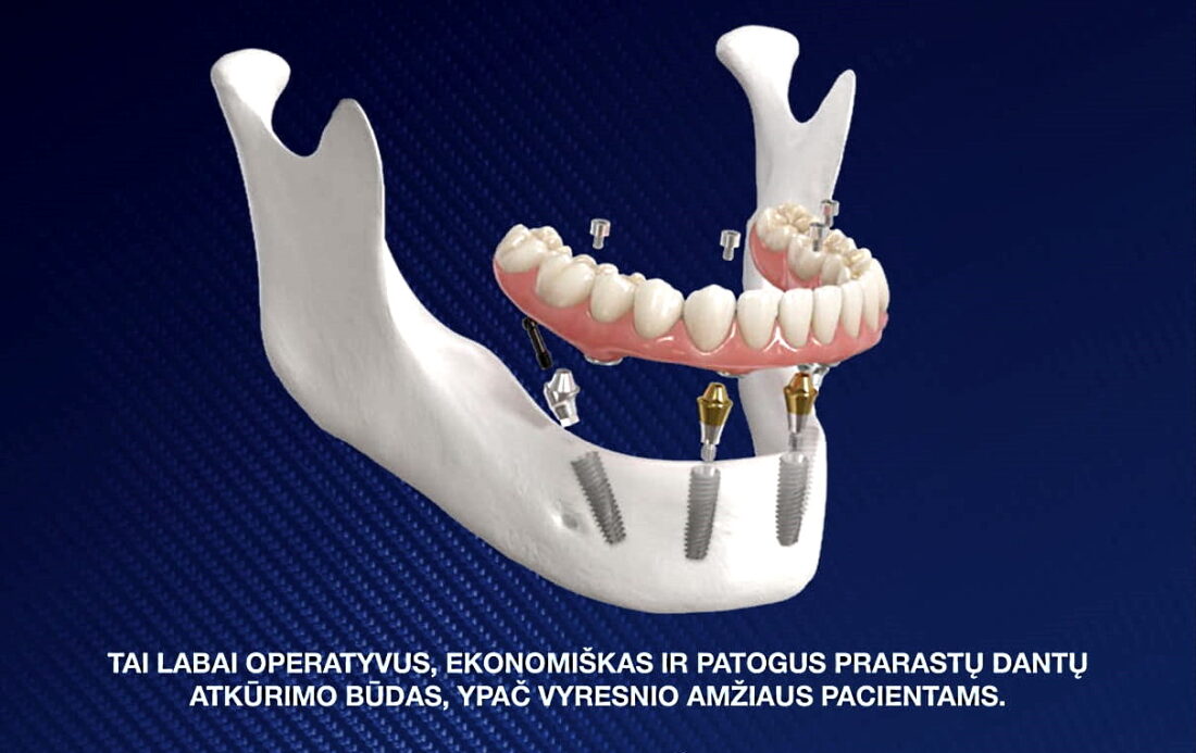 „OSSTEM“ dantų implantai – visaverčiam gyvenimui ir šypsenos grožiui