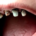„Metamfetamino burna“ ir dantys