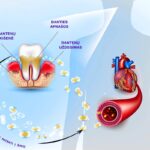 Kaip periodontitas siejamas su kraujotakos ligomis?