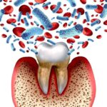 Alzheimerio liga – periodontito komplikacija?