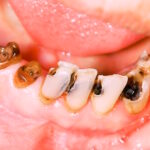 Kaip rūkymas žaloja dantis